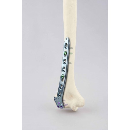 4.0 Distal lateral humerus locking plate.მხრის დისტალურ ლატერალური მაბლოკირებელი ფირფიტა